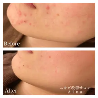 ミディアム カラー パーマ ヘアアレンジ メンズ キッズ ネイル マツエク・マツパ ニキビ跡専門サロン Ａｉｎａのエステ・リラクイメージ