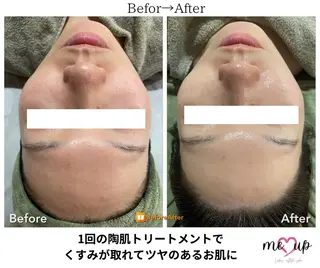 Meupニキビ専門店 背中/ハーブ/肌管理のその他イメージ