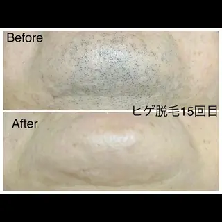 メンズ キッズ 医療提携メンズ脱毛 CDFAkasakaのエステ・リラクイメージ