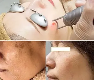 顔脱毛＆毛穴＆ニキビ 優良№1♪ヒロコ♪のエステ・リラクイメージ