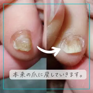 ネイル 深爪・巻き爪 専門サンセリテのネイルデザイン