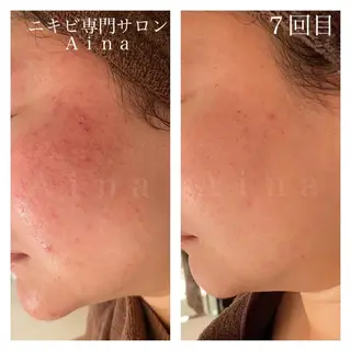 ミディアム カラー パーマ ヘアアレンジ メンズ キッズ ネイル ニキビ跡専門サロン Ａｉｎａのエステ・リラクイメージ