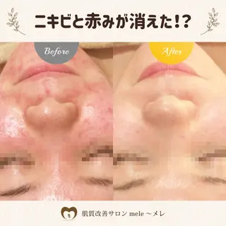 ニキビケア/毛穴/ 赤み/自信の肌✨森園のエステ・リラクイメージ