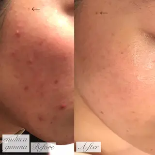 emiluca西目/ 毛穴洗浄/細胞美容のエステ・リラクイメージ