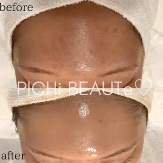 タルミ,ニキビケア専門PICHi BEAUTeピチボーテ所属・トクシゲ マホのエステ・リラクイメージ