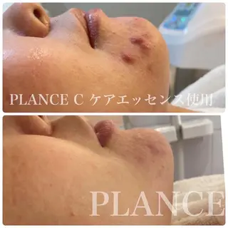 フェイシャル専門 肌質改善/プランスのエステ・リラクイメージ