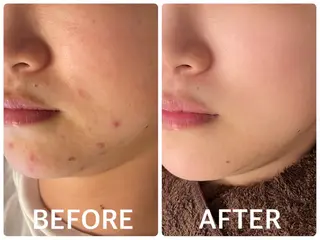 ハーブピーリング 横浜のエステ・リラクイメージ