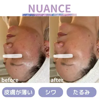 肌質改善|天王寺 For...はるかのエステ・リラクイメージ