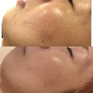 ロング カラー パーマ ヘアアレンジ メンズ キッズ ネイル マツエク・マツパ アイブロウ ニキビ特化型エステ 🍓最短で肌質改善のエステ・リラクイメージ