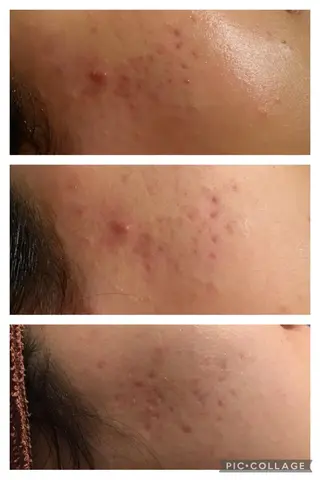 セミロング カラー パーマ ヘアアレンジ メンズ キッズ ネイル マツエク・マツパ アイブロウ ニキビ特化型エステ 🍓最短で肌質改善のエステ・リラクイメージ