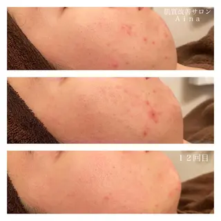 セミロング カラー パーマ ヘアアレンジ メンズ キッズ マツエク・マツパ ニキビ跡専門サロン Ａｉｎａのエステ・リラクイメージ