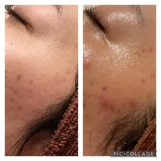 セミロング カラー パーマ ヘアアレンジ メンズ キッズ ネイル マツエク・マツパ アイブロウ ニキビ特化型エステ 🍓最短で肌質改善のエステ・リラクイメージ