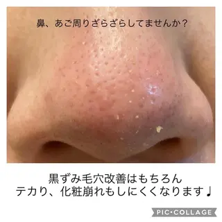 毛穴ケア・肌質改善 徳川のエステ・リラクイメージ