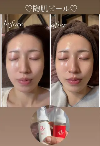 ハーブピーリング/韓国肌管理/フェイシャル/毛穴洗浄/眉毛/顔脱毛【糸脱毛専門】rev所属・ハーブピーリング🌹 毛穴洗浄❤️眉waxのエステ・リラクイメージ