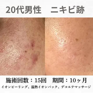 重度ニキビ専門🌷 ダウンタイムなしのエステ・リラクイメージ
