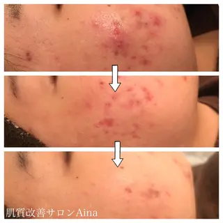 ミディアム キッズ ネイル マツエク・マツパ ニキビ跡専門サロン Ａｉｎａのエステ・リラクイメージ