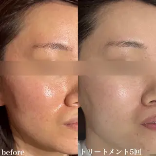 mieux所属・ハーブピーリング ¥6600のエステ・リラクイメージ