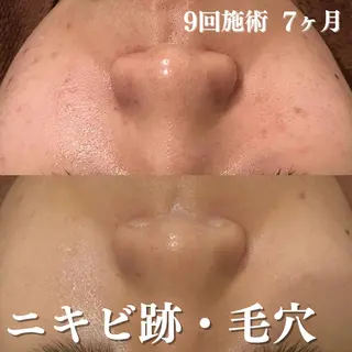 ニキビ跡改善専門🔥 医療にはできない改善のエステ・リラクイメージ