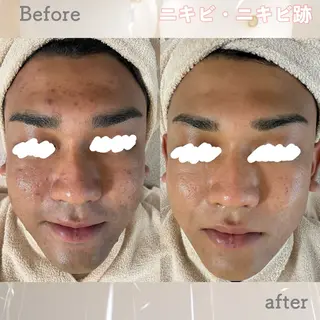 ニキビ&跡改善サロン オーナー光木のエステ・リラクイメージ