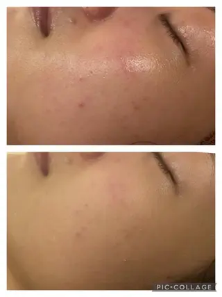 セミロング カラー パーマ ヘアアレンジ メンズ キッズ ネイル マツエク・マツパ アイブロウ 🔥3か月で肌革命 🔥ニキビ専門店のエステ・リラクイメージ