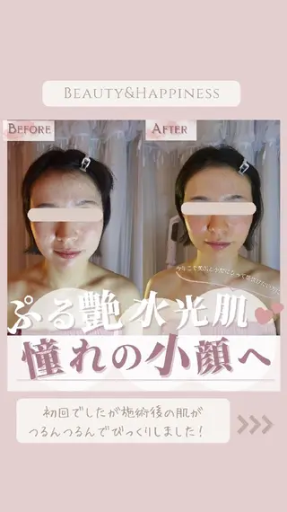 痩身ハーブピーリング 筋膜リリース☆B&Hのエステ・リラクイメージ