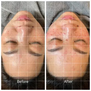 肌改善グリーンピール 東川口/浦和美園のエステ・リラクイメージ