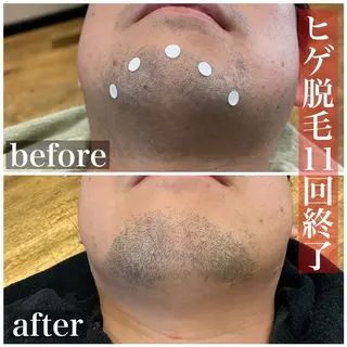 メンズ HAIRS YOSHIOKA所属・ヘアーズヨシオカ MENSヒゲ脱毛のエステ・リラクイメージ