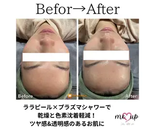 Meupニキビ専門店 背中/ハーブ/肌管理のその他イメージ