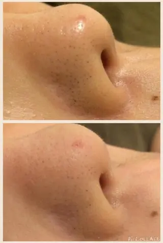 夏までに肌荒れ卒業 するサロン🌻のエステ・リラクイメージ