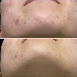 ニキビケア Moto rihi【モトリヒ】のエステ・リラクイメージ