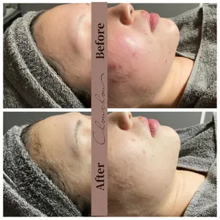 beauty & health salon Chou chou所属・ニキビ・毛穴🌿肌を 育てるララピール✨のエステ・リラクイメージ