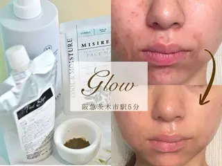 【医療提携】幹細胞艶玉ハーブピーリング　glow所属・肌質改善専門 【医療提携】glowのエステ・リラクイメージ