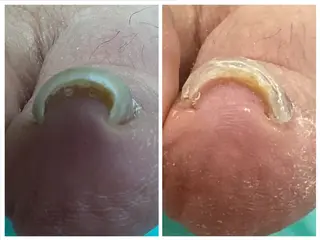 巻き爪補正店 大阪なんば店のネイルデザイン