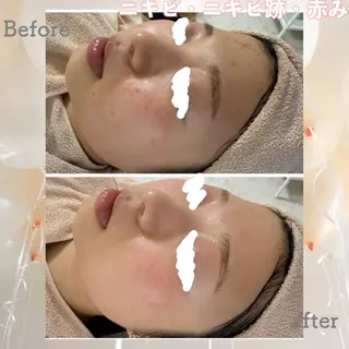 ニキビ&跡改善サロン オーナー光木のエステ・リラクイメージ