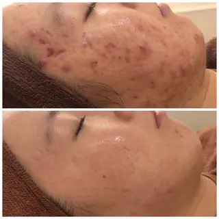 セミロング カラー パーマ ヘアアレンジ メンズ キッズ ネイル マツエク・マツパ アイブロウ ニキビ特化型エステ 🍓最短で肌質改善のエステ・リラクイメージ