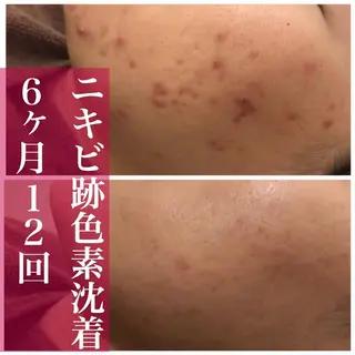 ロング カラー パーマ ヘアアレンジ メンズ キッズ ネイル マツエク・マツパ 都内で出来る肌管理！ 最短ニキビ改善のエステ・リラクイメージ