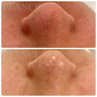 フェイシャル専門 肌質改善/プランスのエステ・リラクイメージ