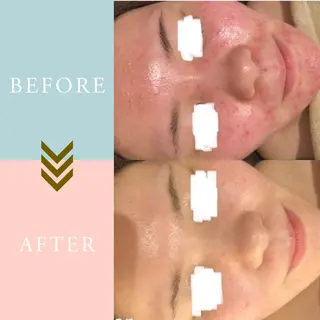 ニキビケア/毛穴/ 赤み/自信の肌✨森園のエステ・リラクイメージ