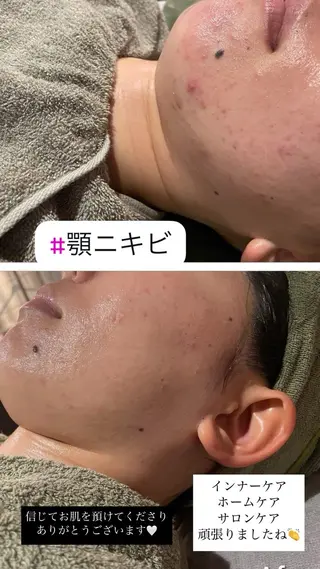 Meupニキビ専門店 背中/ハーブ/肌管理のその他イメージ