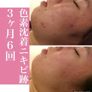 ニキビ・肌質改善専門 ♡人生が変わるサロンのエステ・リラクイメージ