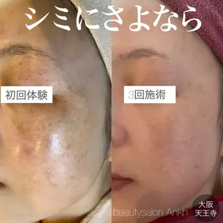 【しみ毛穴専門店】beautysalon Ankh所属・しみ毛穴専門店 Ankh 平田のエステ・リラクイメージ