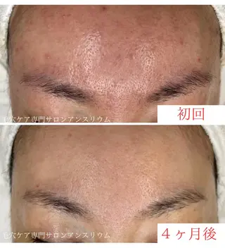 毛穴ケア専門サロンアンスリウム所属・茨城土浦 つくば毛穴 ケア専門サロンのエステ・リラクイメージ