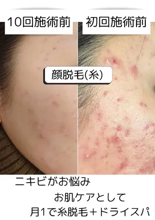 【糸脱毛×ドライヘッドスパ×お肌】salon LUOLA所属・salon LUOLAのヘアスタイル