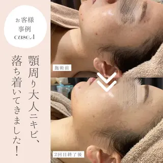 和漢よもぎ蒸しとフェイシャルのお店　maison de beaute所属・よもぎ蒸し/ 大人ニキビ　mamiのエステ・リラクイメージ