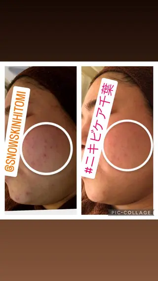 ニキビ/肌質改善専門 Snow skinのエステ・リラクイメージ