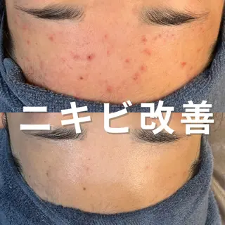 ニキビ・ニキビ跡改善 leoloのエステ・リラクイメージ