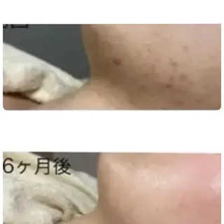 エイジングケアサロンBIOEL所属・肌質改善BIOELプ ラズマ/ラミピールのエステ・リラクイメージ