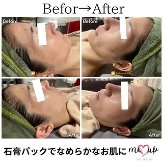 Meupニキビ専門店 背中/ハーブ/肌管理のその他イメージ