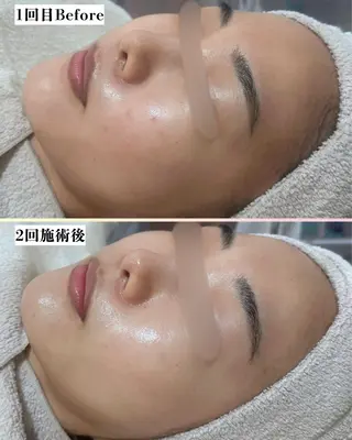 |ピーリング・毛穴| soina神楽坂のエステ・リラクイメージ