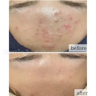 ハーブピーリング🌹 Homieのエステ・リラクイメージ